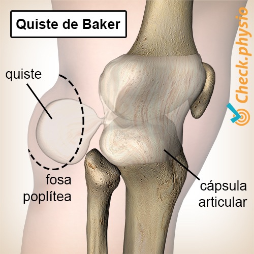 rodilla quiste poplíteo de bakers