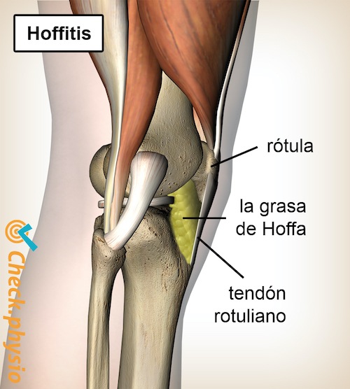 rodilla almohadilla de grasa de Hoffa hoffitis