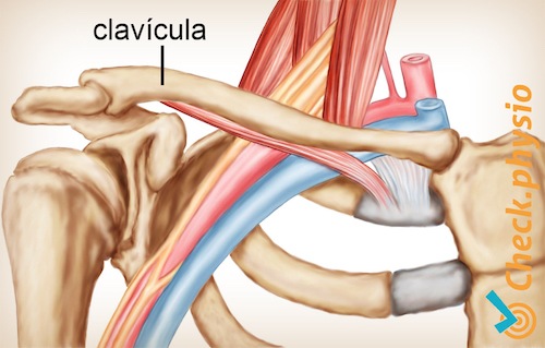 hombro brazo mano síndrome de salida torácica clavícula