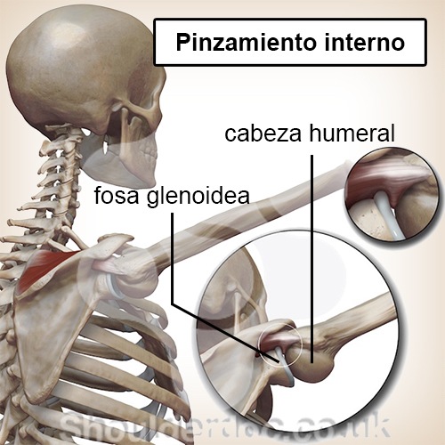 hombro pinzamiento interno cabeza humeral cavidad fosa glenoidea