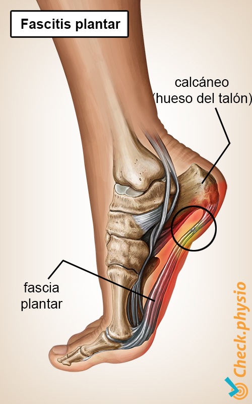 pie fascitis plantar aponeurosis espolón calcáneo