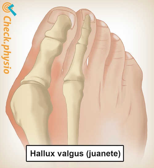 pie hallux valgus anatomía