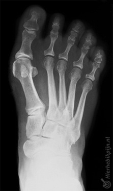 pie hallux valgus radiografía