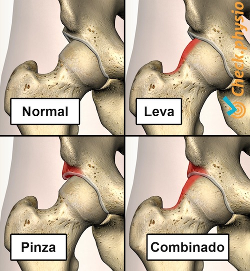 cadera pinzamiento femoroacetabular fai tipos