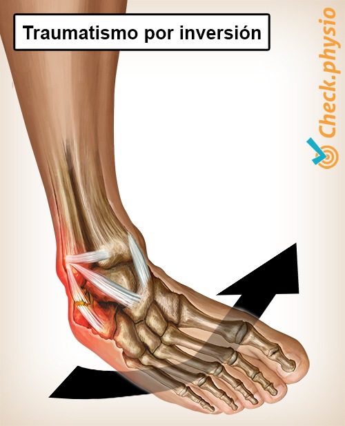 tobillo traumatismo por inversión del tobillo anatomía ligamentos del tobillo