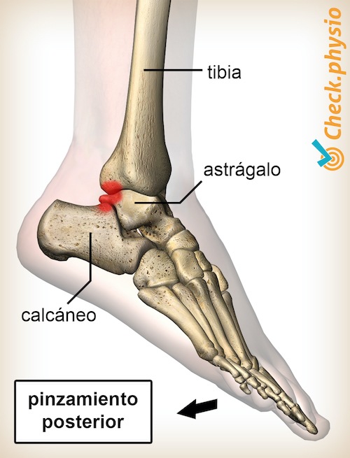 pinzamiento posterior del tobillo flexión plantar