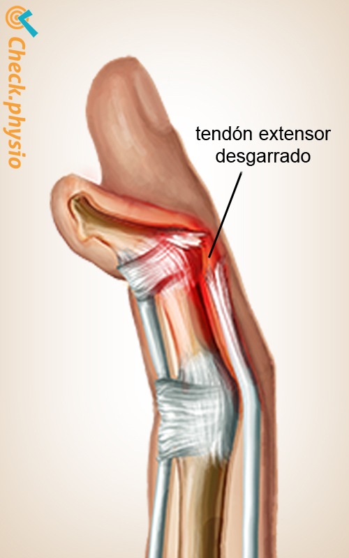 mano dedo martillo anatomía