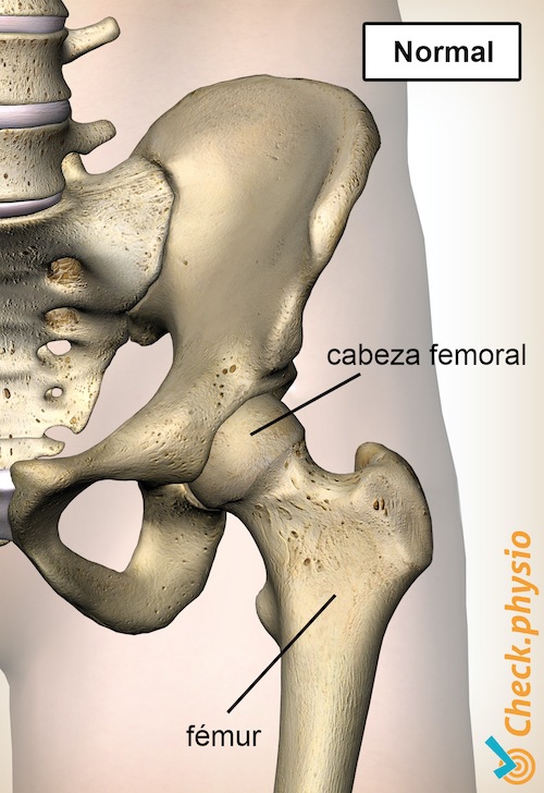 cadera epifisiolisis cabeza femoral normal