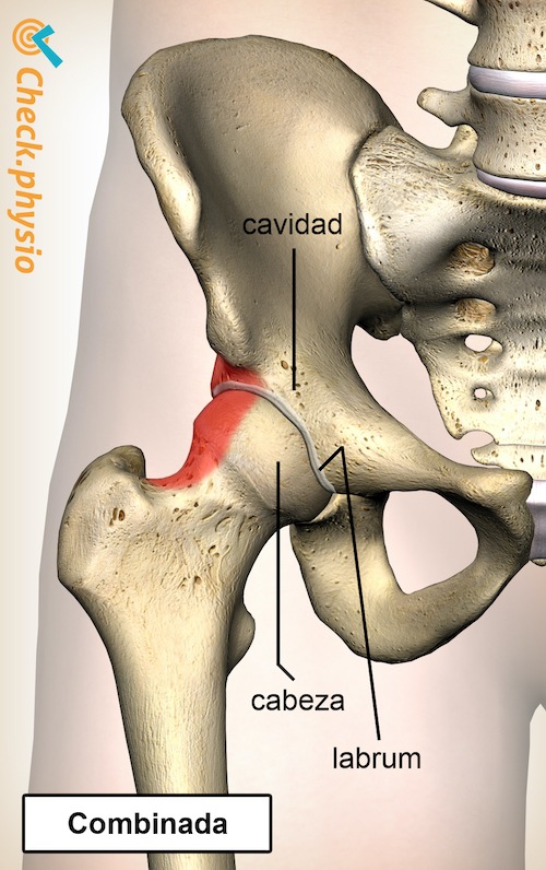 cadera pinzamiento femoroacetabular fai combinada