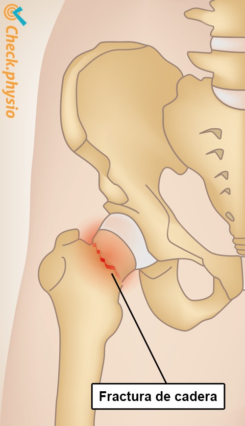 fractura de cadera anatomía